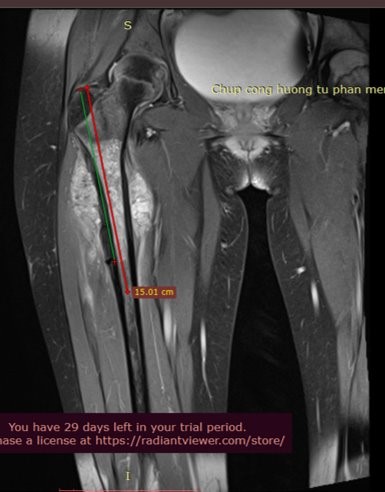 MRI of N.H.'s tumor, which received successful aggressive treatment at Vinmec